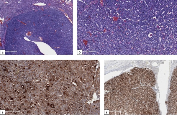 [Metastatic lesions of the adrenal glands. The experience of Endocrinology Research Center.]