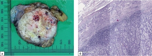 [Metastatic lesions of the adrenal glands. The experience of Endocrinology Research Center.]