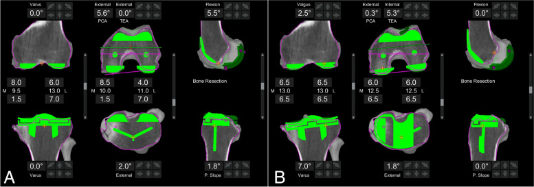 Arithmetic hip knee angle measurement on long leg radiograph versus computed tomography-inter-observer and intra-observer reliability.