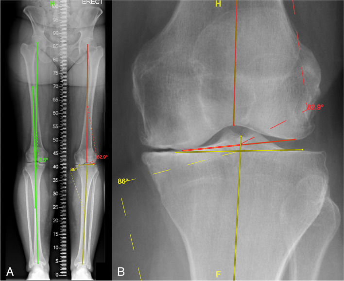 Arithmetic hip knee angle measurement on long leg radiograph versus computed tomography-inter-observer and intra-observer reliability.