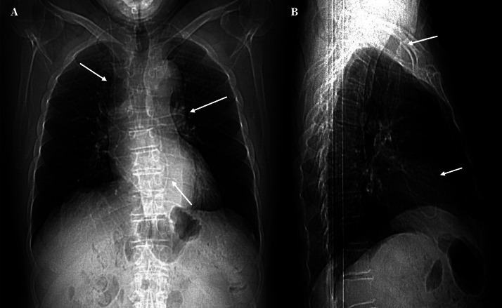 [Distal ventriculoperitoneal shunt catheter migration into the pulmonary artery: a rare complication].