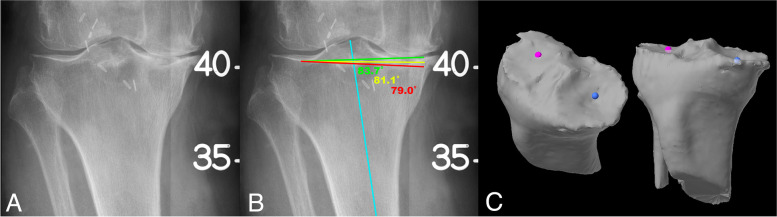 Arithmetic hip knee angle measurement on long leg radiograph versus computed tomography-inter-observer and intra-observer reliability.