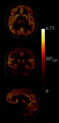 Preliminary Assessment of Reference Region Quantification and Reduced Scanning Times for [<sup>18</sup>F]SynVesT-1 PET in Parkinson's Disease.