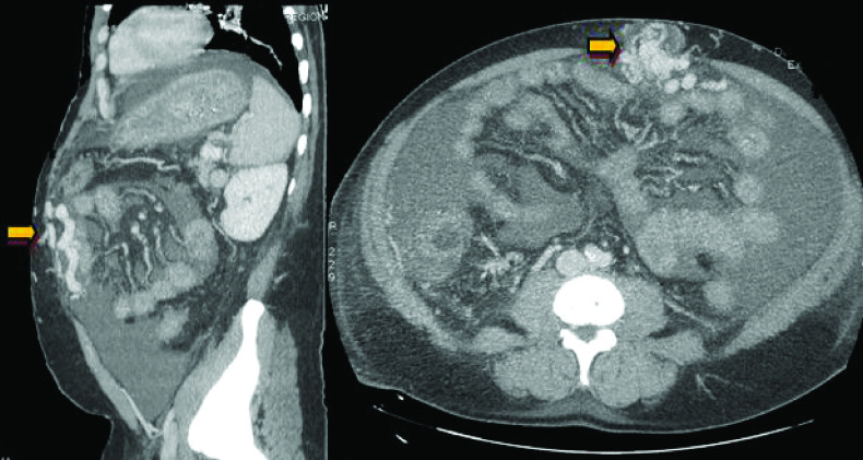 A rare cause of spontaneous hemoperitoneum: intra-abdominal vein rupture.