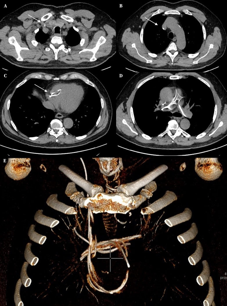 [Distal ventriculoperitoneal shunt catheter migration into the pulmonary artery: a rare complication].