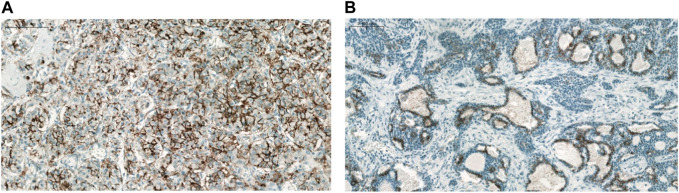 Claudin expression in pulmonary adenoid cystic carcinoma and mucoepidermoid carcinoma.