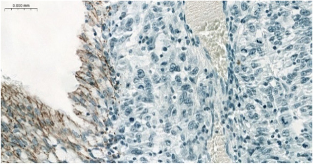 Claudin expression in pulmonary adenoid cystic carcinoma and mucoepidermoid carcinoma.