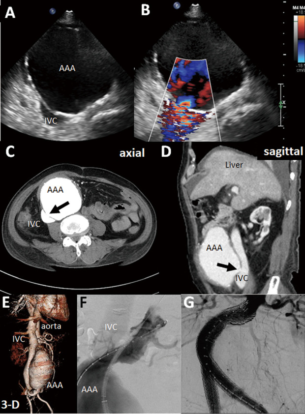 High-Output Heart Failure Caused by Abdominal Aortic Aneurysm-Inferior Vena Cava Fistula Due to Blunt Trauma.