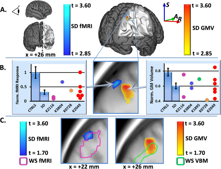 Dorsal visual stream and LIMK1: hemideletion, haplotype, and enduring effects in children with Williams syndrome.