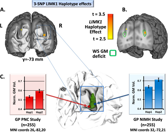 Dorsal visual stream and LIMK1: hemideletion, haplotype, and enduring effects in children with Williams syndrome.