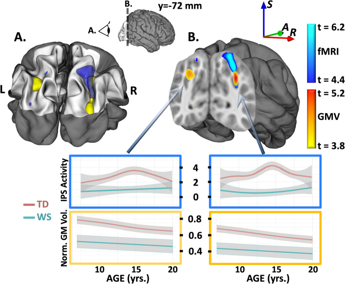 Dorsal visual stream and LIMK1: hemideletion, haplotype, and enduring effects in children with Williams syndrome.