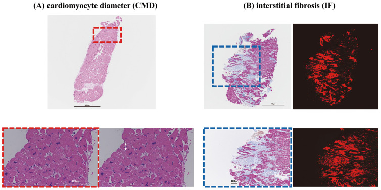 Relationship Between Results of Pathological Evaluation of Endomyocardial Biopsy and Echocardiographic Indices in Patients With Non-Ischemic Cardiomyopathy.