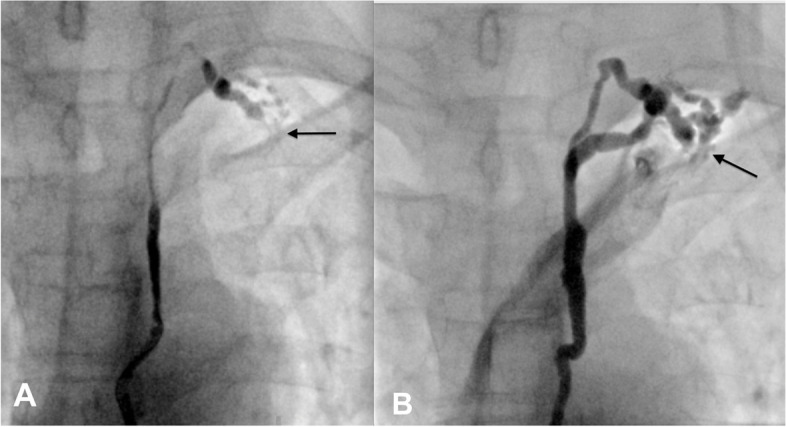 Occlusion of thoracic duct stent resulting in recurrent chyluria: role of renal-lymphatic fistula embolization.