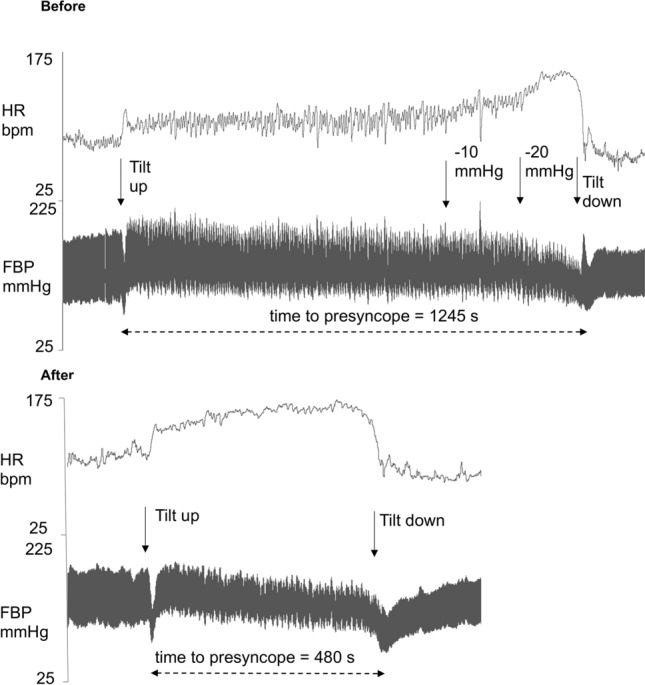 Effects of daily artificial gravity training on orthostatic tolerance following 60-day strict head-down tilt bedrest.