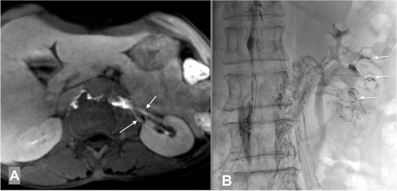 Occlusion of thoracic duct stent resulting in recurrent chyluria: role of renal-lymphatic fistula embolization.