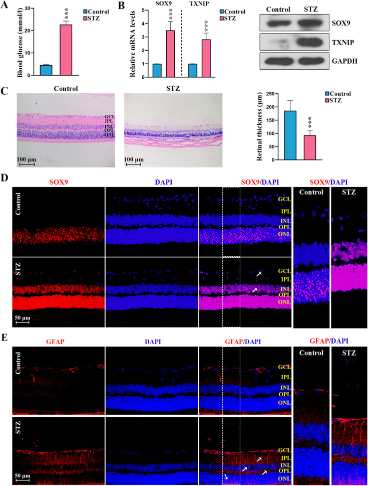 SRY-box transcription factor 9 modulates Müller cell gliosis in diabetic retinopathy by upregulating TXNIP transcription.