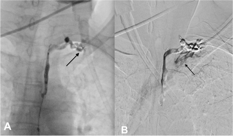 Occlusion of thoracic duct stent resulting in recurrent chyluria: role of renal-lymphatic fistula embolization.