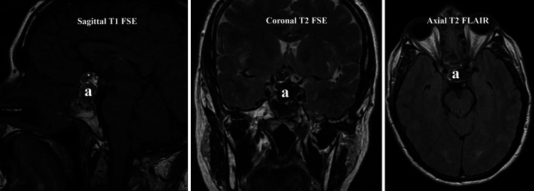 Bilateral visual disturbances caused by a glomus vagale: illustrative case.
