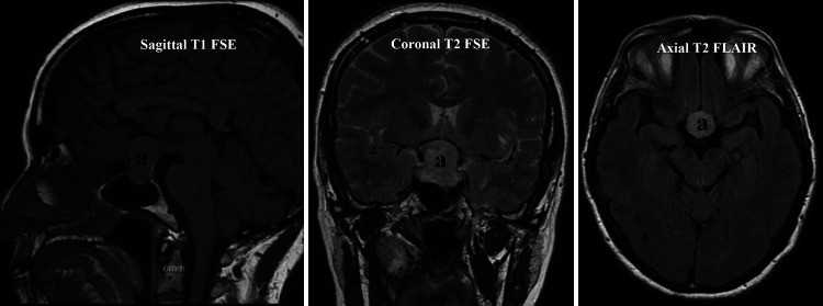Bilateral visual disturbances caused by a glomus vagale: illustrative case.