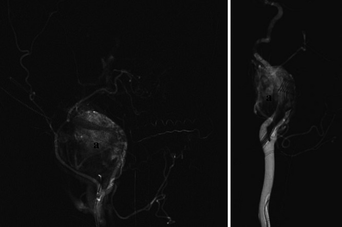 Bilateral visual disturbances caused by a glomus vagale: illustrative case.