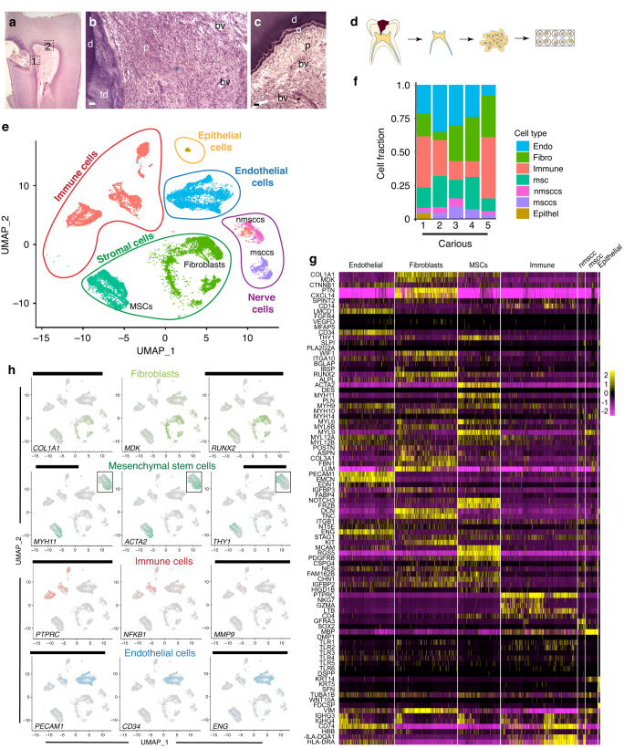 Extracellular matrix remodelling in dental pulp tissue of carious human teeth through the prism of single-cell RNA sequencing.