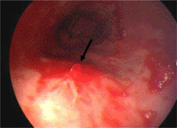 Upper gastrointestinal bleeding due to Dieulafoy's lesion of the stomach: a rare case report.