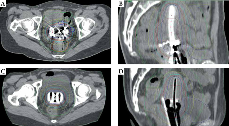 Dosimetric comparison of rectal dose-reductive techniques in intra-cavitary brachytherapy for cervical cancer: A retrospective analysis.