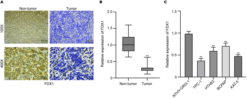 FDX1 inhibits thyroid cancer malignant progression by inducing cuprotosis.