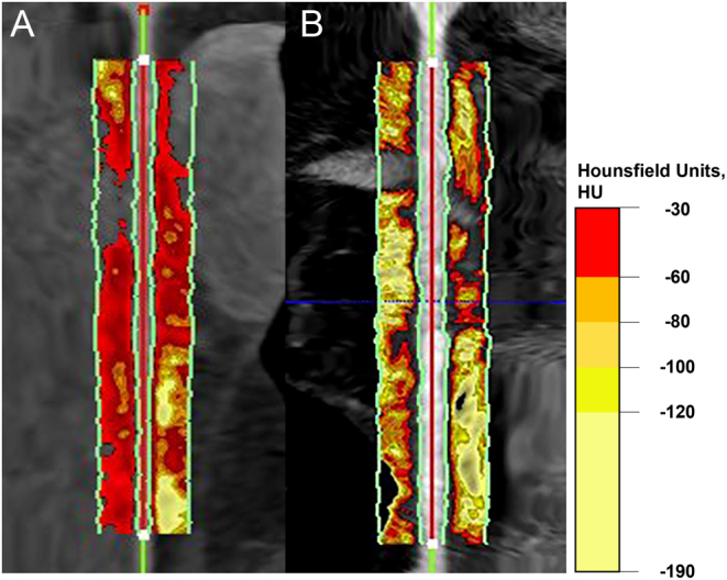 Semaglutide therapy decreases epicardial fat inflammation and improves psoriasis severity in patients affected by abdominal obesity and type-2 diabetes.