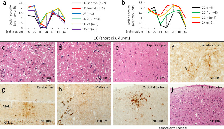 Novel histotypes of sporadic Creutzfeldt-Jakob disease linked to 129MV genotype.