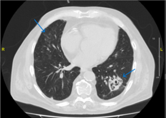 Pulmonary nocardiosis after covid-19 infection: case report and literature review.