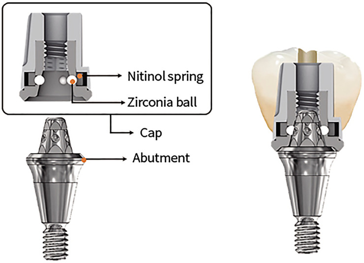 A prospective multicenter clinical study on the efficiency of detachable ball- and spring-retained implant prosthesis.