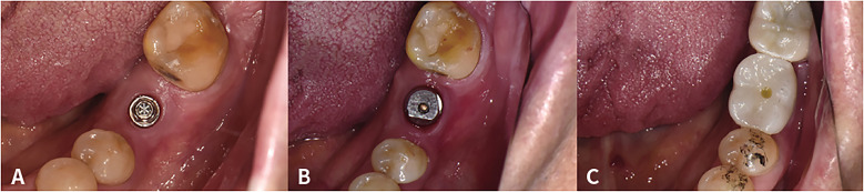 A prospective multicenter clinical study on the efficiency of detachable ball- and spring-retained implant prosthesis.