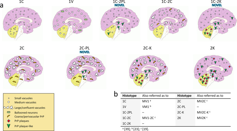 Novel histotypes of sporadic Creutzfeldt-Jakob disease linked to 129MV genotype.