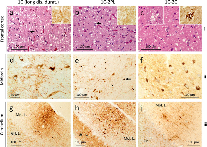 Novel histotypes of sporadic Creutzfeldt-Jakob disease linked to 129MV genotype.