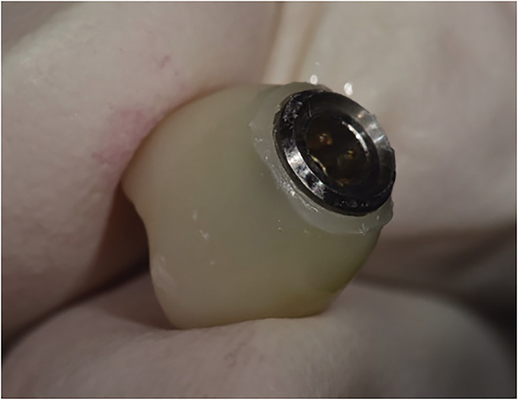 A prospective multicenter clinical study on the efficiency of detachable ball- and spring-retained implant prosthesis.