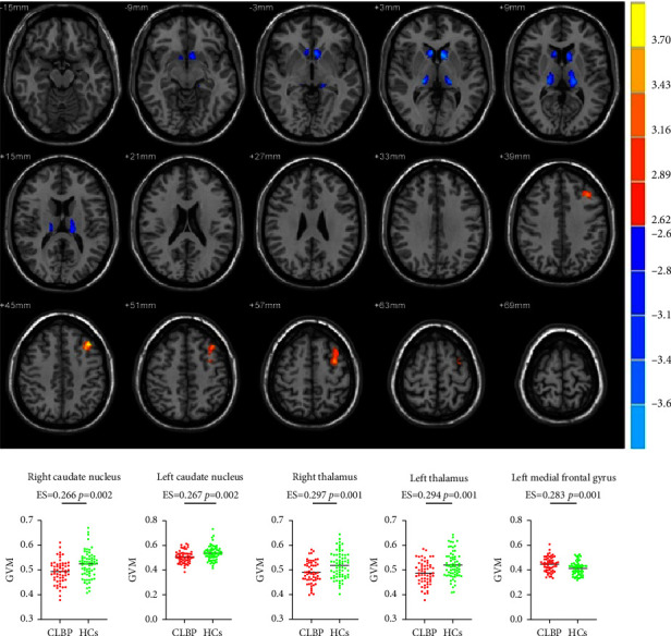 Functional Alterations of the Basal Ganglia Are Associated with Voluntary Activation of the Core Stabilizing Muscles in Patients with Chronic Low Back Pain: A Cross-Sectional Study.