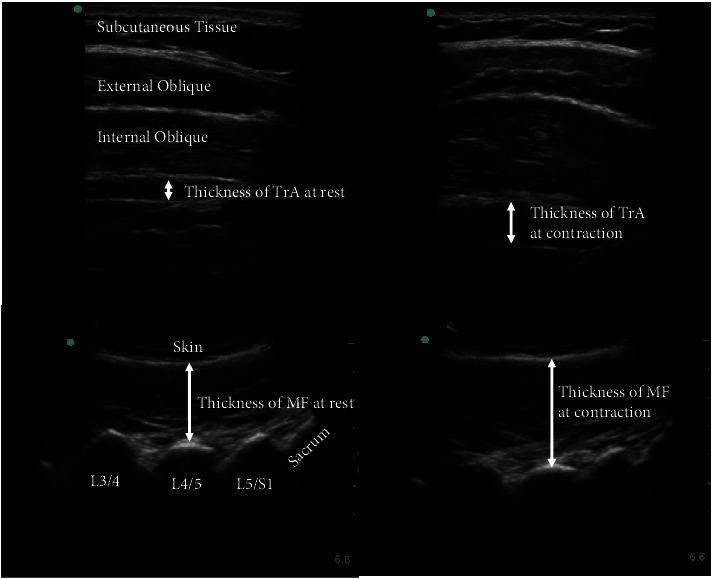 Functional Alterations of the Basal Ganglia Are Associated with Voluntary Activation of the Core Stabilizing Muscles in Patients with Chronic Low Back Pain: A Cross-Sectional Study.