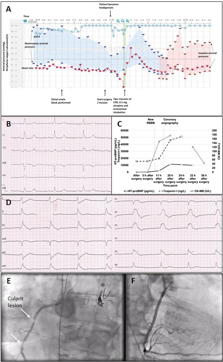 A case of recurring perioperative circulatory arrest: mind the autonomic nervous system.