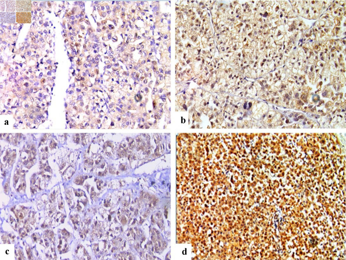 FOS-Like Antigen 1 Expression Was Associated With Survival of Hepatocellular Carcinoma Patients.