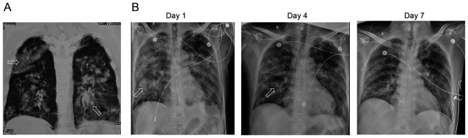 Treatment with sivelestat sodium of acute respiratory distress syndrome induced by chemical pneumonitis: A report of three cases.