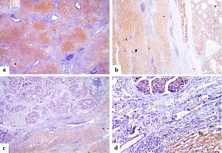 FOS-Like Antigen 1 Expression Was Associated With Survival of Hepatocellular Carcinoma Patients.