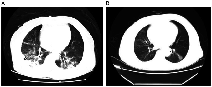 Treatment with sivelestat sodium of acute respiratory distress syndrome induced by chemical pneumonitis: A report of three cases.