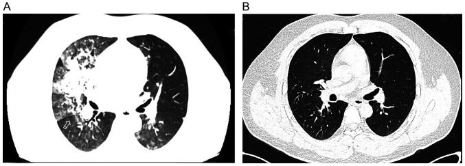 Treatment with sivelestat sodium of acute respiratory distress syndrome induced by chemical pneumonitis: A report of three cases.