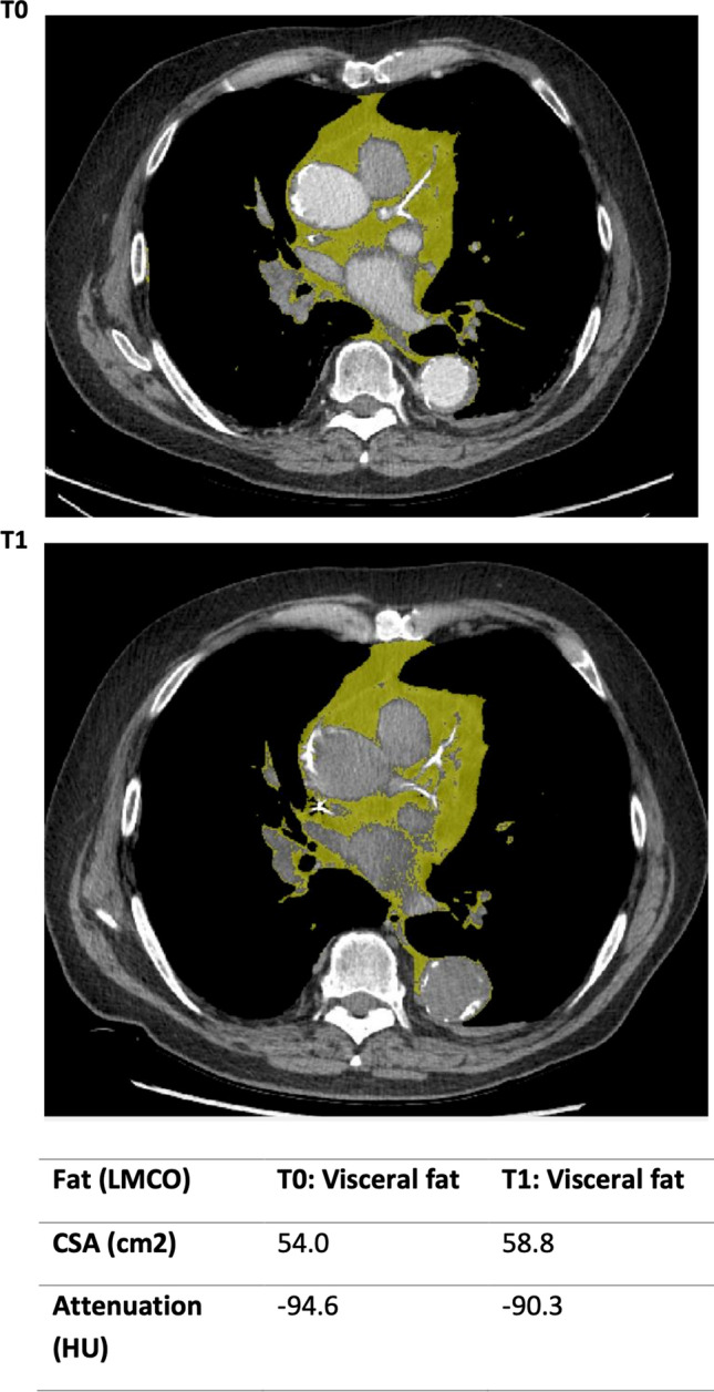 Analytic Morphomics in Myositis-Related Interstitial Lung Disease.