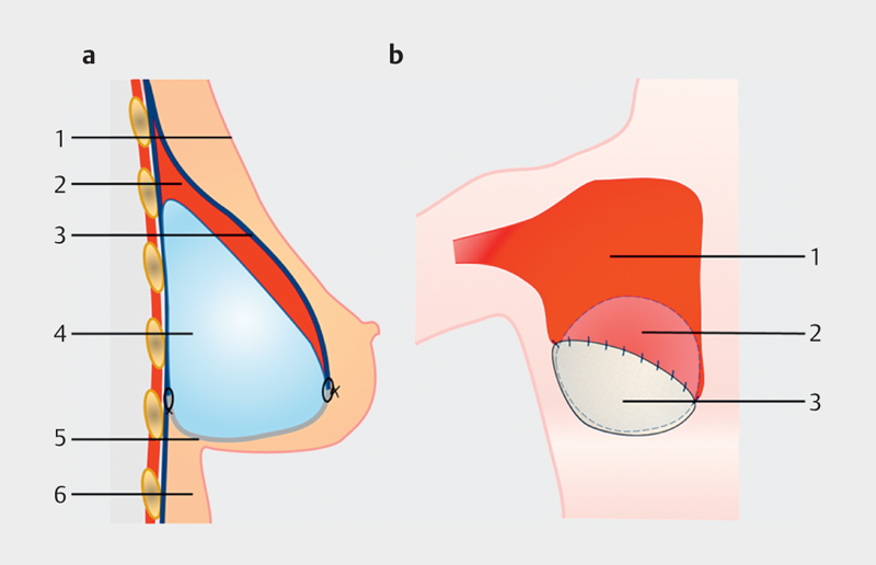 [Update and Trends in Breast Reconstruction After Mastectomy].