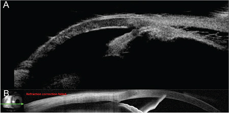 Cyclodialysis Cleft and Hypotony Following Combined Phacoemulsification and Excisional Goniotomy with the Kahook Dual Blade.