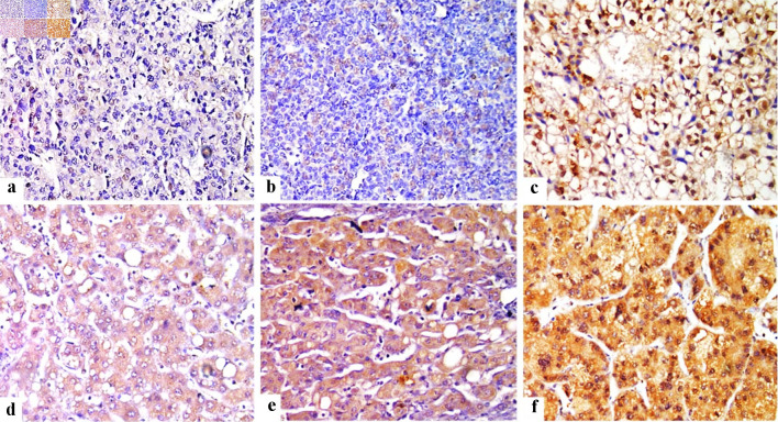 FOS-Like Antigen 1 Expression Was Associated With Survival of Hepatocellular Carcinoma Patients.