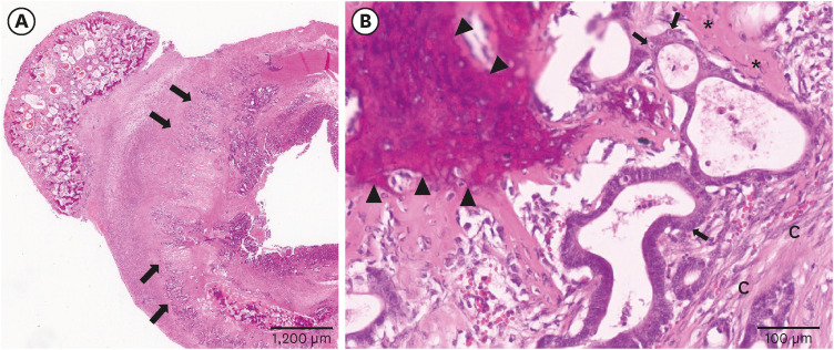 Metastatic intestinal adenocarcinoma with osseous metaplasia in two Domestic Korean Shorthair cats.