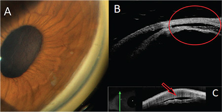 Cyclodialysis Cleft and Hypotony Following Combined Phacoemulsification and Excisional Goniotomy with the Kahook Dual Blade.